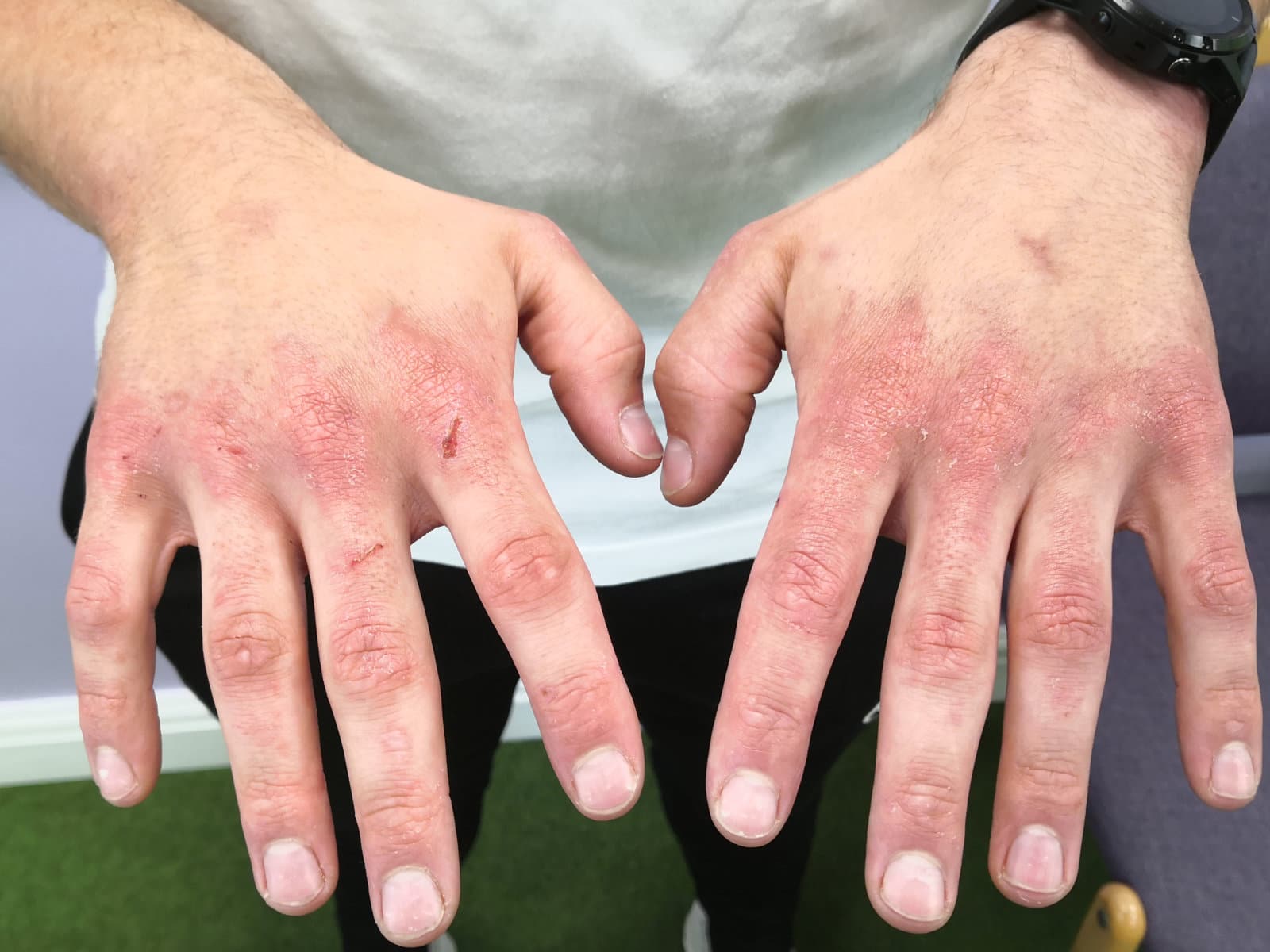 Image of skin on the hands after PBM Therapy