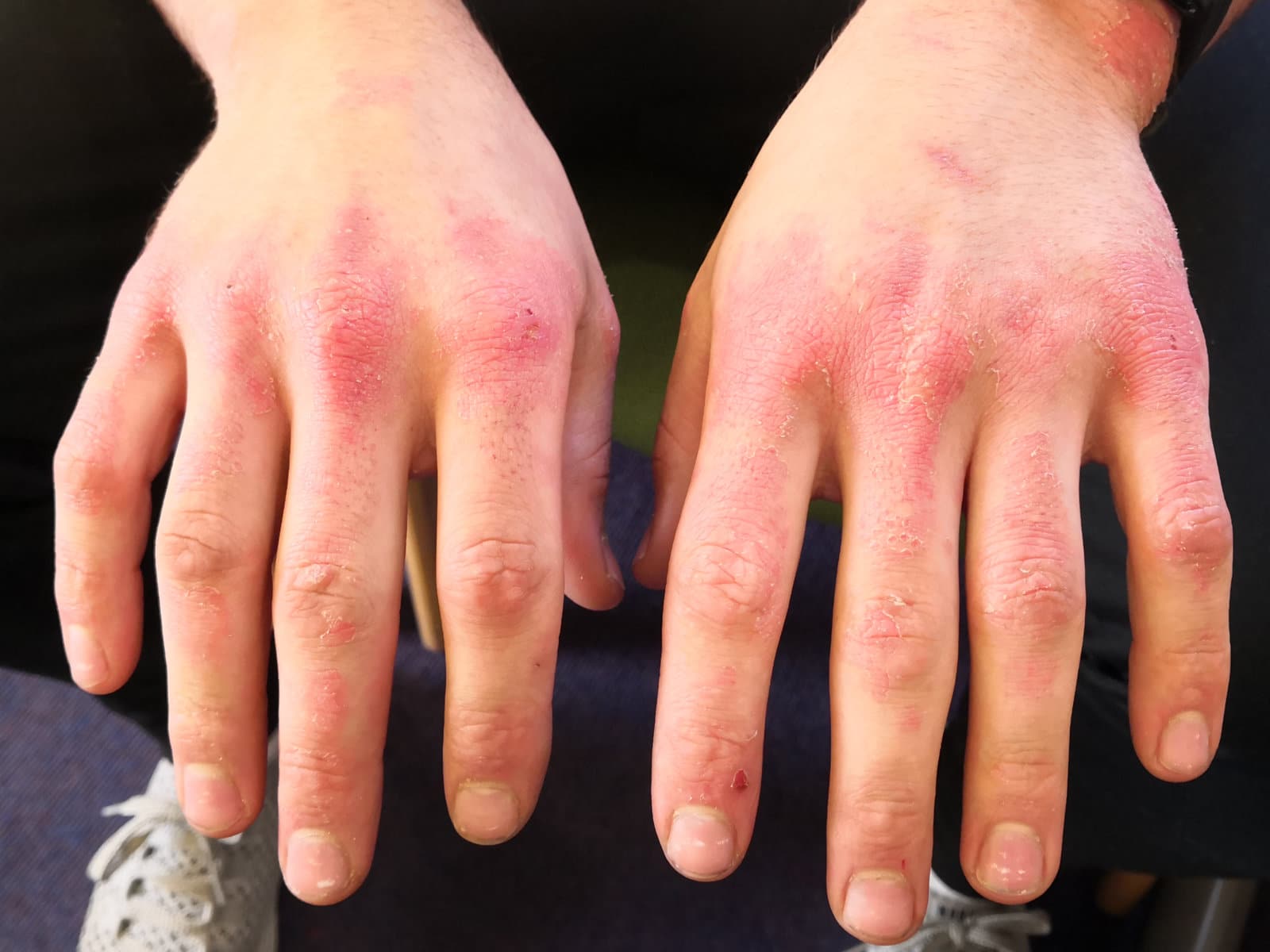 Image of skin on the hands before PBM Therapy