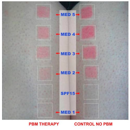 PBM Therapy Prevents UV Skin Damage